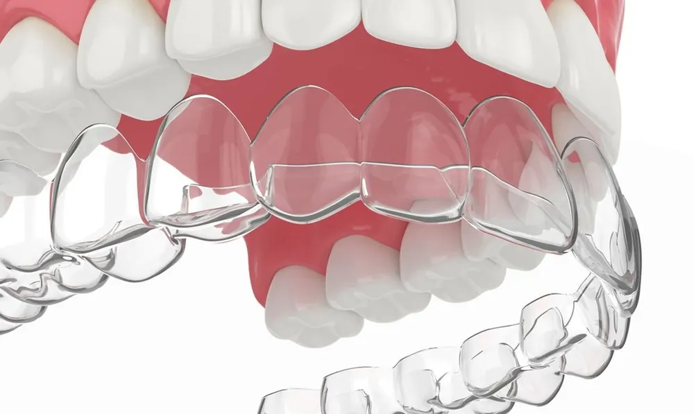 Clear Aligners at Taylors Rd Dental, Kings Park