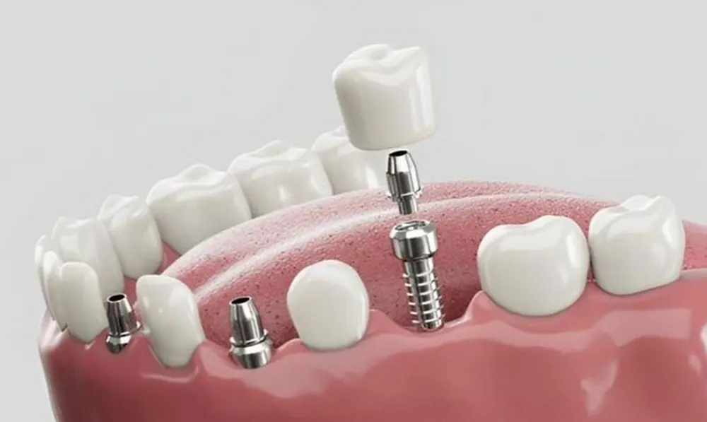 All-On-4 Implants at Taylors Rd Dental, Kings Park