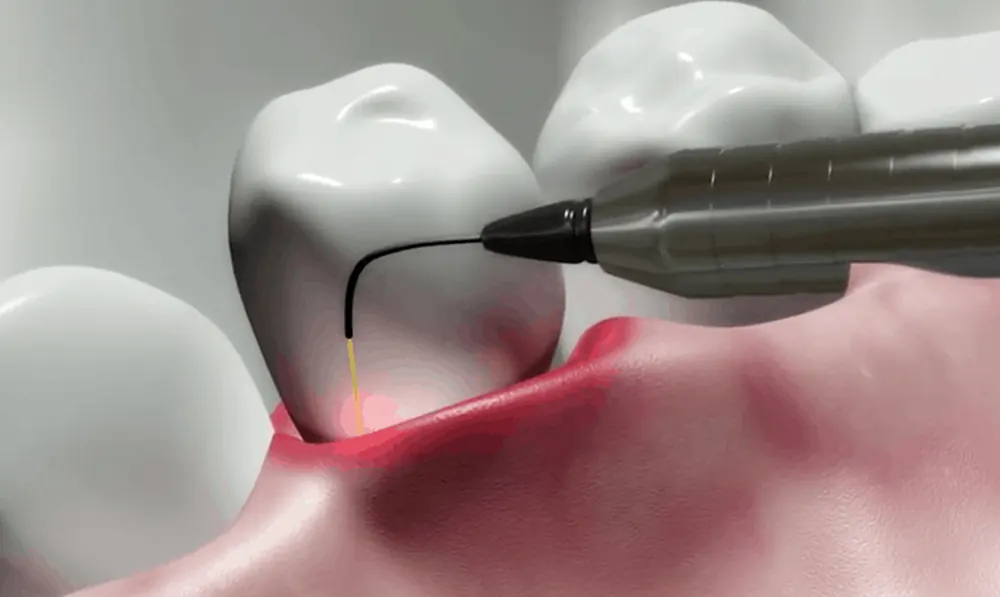 Laser Dentistry at Taylors Rd Dental, Kings Park