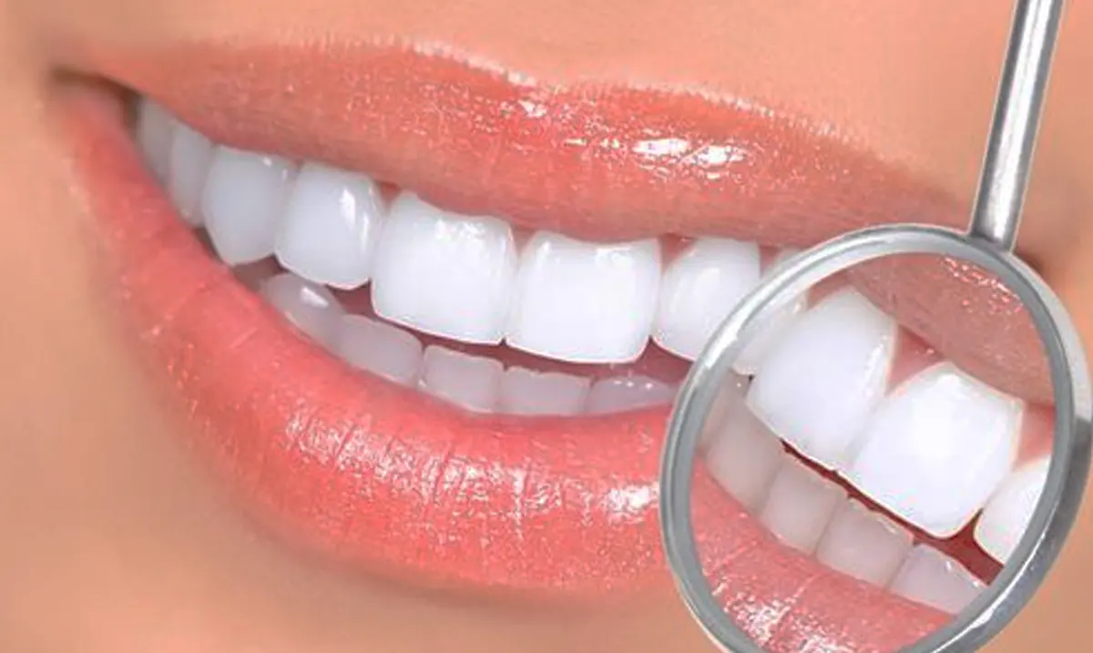 Smile makeover close-up