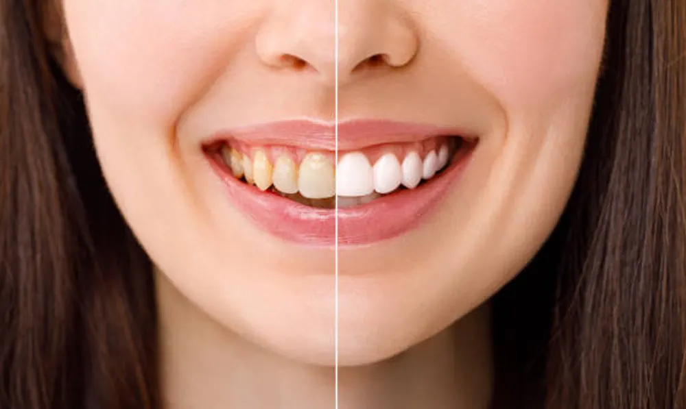 Teeth Whitening at Taylors Rd Dental, Kings Park
